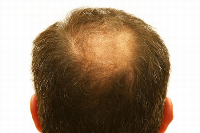 regrow hair naturally male pattern baldness